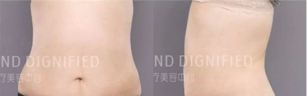 前年做的腰腹吸脂没效果,今年在长春姬安娣整形吸脂瘦腹后终于圆了我的减肥梦! 图2
