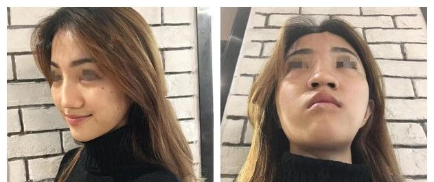 看无锡丽都真实案例鼻子效果自然，也去面诊做了硅胶假体隆鼻+耳软骨垫鼻尖改善自己的猪鼻子