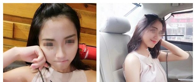 看无锡丽都真实案例鼻子效果自然，也去面诊做了硅胶假体隆鼻+耳软骨垫鼻尖改善自己的猪鼻子 案例图2