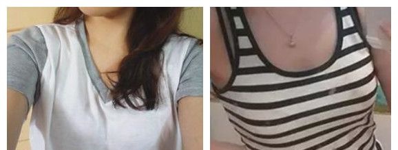南宁正规丰胸医院是哪家?本人在南宁韩星整形做自体脂肪隆胸,恢复30天效果是这样的...