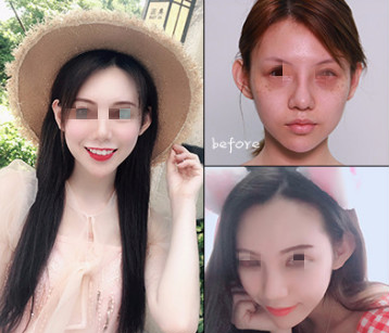 在烟台做的激光祛斑的手术，不贵也就几千块而已但是效果真的让我很惊讶