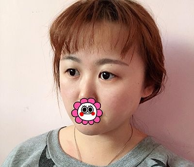 哈尔滨索菲刘刚做的芭比眼综合恢复30天效果，大家觉着怎么样？