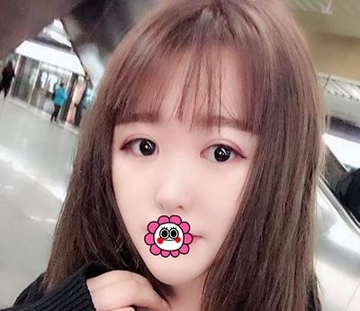 哈尔滨索菲刘刚做的芭比眼综合恢复30天效果，大家觉着怎么样？ 案例图2