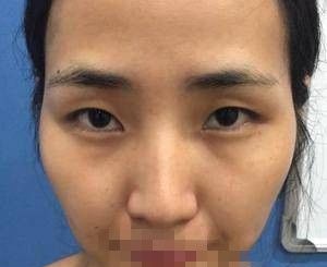 做双眼皮加开眼角后 随便发了一张照片大家居然说我P图了吧