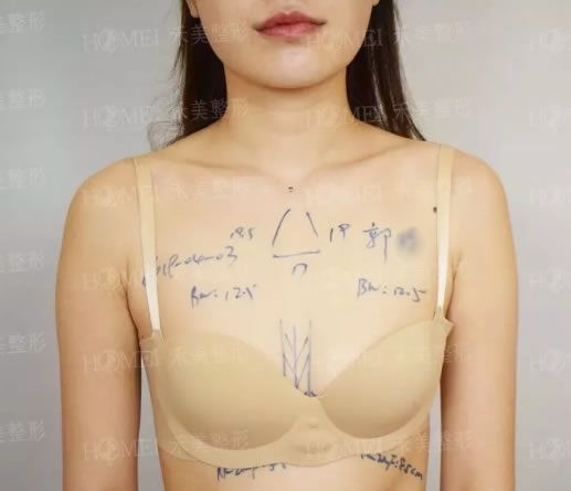 嘉兴禾美做隆胸怎么样?2个月前找曹海峰医生做了假体隆胸的我有话说