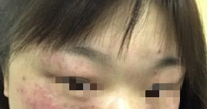 花不到两千在淄博做了激光祛斑手术术后30天来分享照片+心得体会