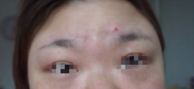 花不到两千在淄博做了激光祛斑手术术后30天来分享照片+心得体会 案例图2