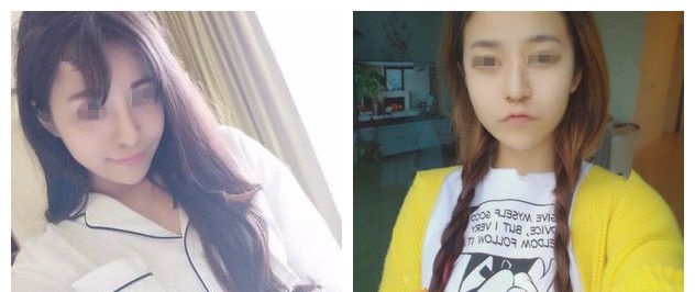 因为胸小惨遭分手后的她花一万多到无锡丽都做了进口娜绮丽假体隆胸，三个月性感身材逆袭打脸前任