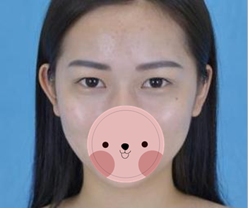 看看宜宾韩美詹清做的双眼皮术后一个月恢复效果图 我觉得自己现在美得不得了