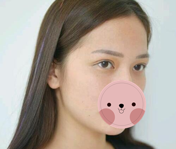 看看宜宾韩美詹清做的双眼皮术后一个月恢复效果图 我觉得自己现在美得不得了 图2