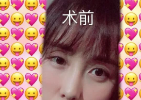 我居然在汉中做了假体隆鼻手术,价格倒不贵但是结果让我很惊喜