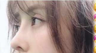 我居然在汉中做了假体隆鼻手术，价格倒不贵但是结果让我很惊喜 案例图2