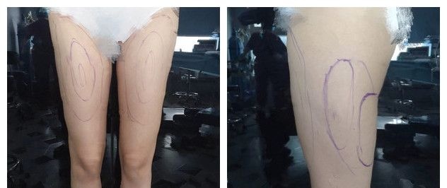扬州美贝尔SX导航吸脂是技术噱头包装吗?看过原理、案例、反馈后面诊医生做了大腿吸脂抽了1500ml脂肪