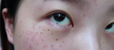潍坊华美创和做激光祛斑蛮不错的，而且收费价格也不贵哦