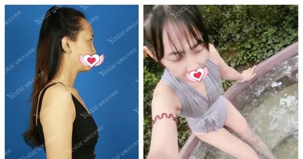 公布昆明艺星金辉做硅胶假体丰胸案例效果对比图,来揭晓隆胸假体会不会出现移位