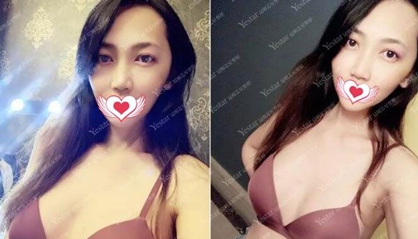 公布昆明艺星金辉做硅胶假体丰胸案例效果对比图,来揭晓隆胸假体会不会出现移位 案例图2