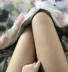 青岛华颜美做大腿吸脂手术真的很不错,看我恢复后的照片就知道了 图2