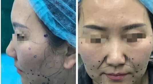甘肃线雕哪家医院好 兰州崔大夫整形面部埋线提升+下颌缘吸脂即刻效果展示