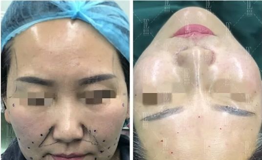 甘肃线雕哪家医院好 兰州崔大夫整形面部埋线提升+下颌缘吸脂即刻效果展示 图2