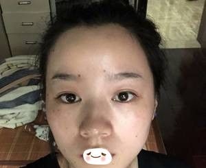 内双做哪种双眼皮好?可以参考我在张家口维多利亚做全切双眼皮术后变5mm自然平扇形双眼皮的效果