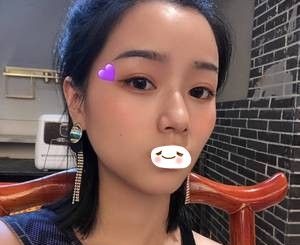 内双做哪种双眼皮好?可以参考我在张家口维多利亚做全切双眼皮术后变5mm自然平扇形双眼皮的效果 图2