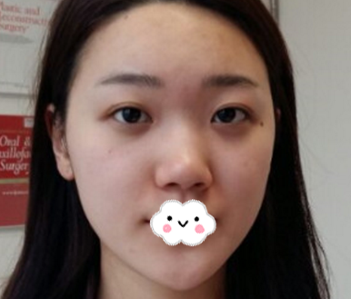 东莞西妃刘波做的鼻子真的太美了,说是妈生鼻也不为过哦