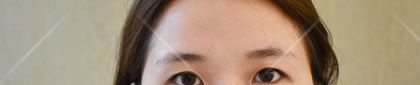 周其光医生在绍兴金柯桥医院坐诊了,看我找周其光割双眼皮后恢复的怎么样,效果好吗