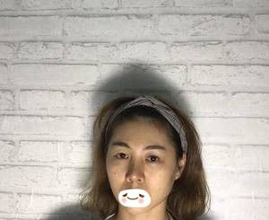 遗传单眼皮+面部凹陷让我很烦恼 没想到找张家口维多利亚姜涛医生做了全切双眼皮术和自体脂肪填充面部后效果如同换脸