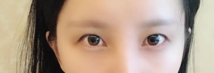 我是一例温州艺星做神话眼综合双眼皮和肋骨鼻综合整形案例,在这里分享我的亲身经验