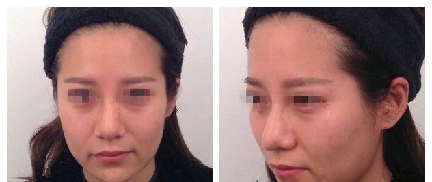 法令纹很深怎么办?看无锡丽都案例教你用爱芙莱玻尿酸填充1ml的用量年轻5岁维持1年时间