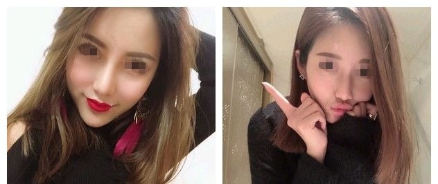 法令纹很深怎么办?看无锡丽都案例教你用爱芙莱玻尿酸填充1ml的用量年轻5岁维持1年时间 图2