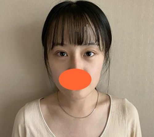 西宁哪家医院可以做自体脂肪填充?看完我一个月前在西宁时光做脂肪填充全脸恢复图及价格就知道了