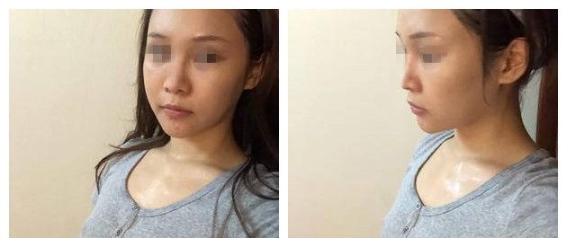 打听到苏州紫馨有别家没有的脂肪胶填充 趁活动8000多做的全面部脂肪填充效果不错一次成活率就很高