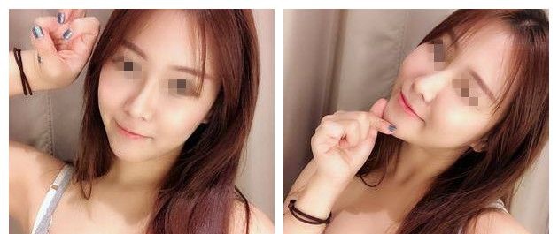 打听到苏州紫馨有别家没有的脂肪胶填充 趁活动8000多做的全面部脂肪填充效果不错一次成活率就很高 图2