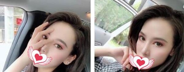 找昆明博美陈茂年做综合双眼皮20天后,又做了玻尿酸填充泪沟,看效果是这样的 图2