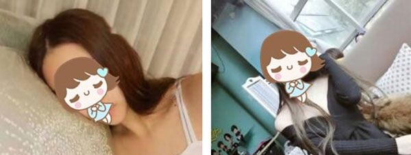我太瘦了做不成自体脂肪丰胸,于是找昆明博美刘小星院长做了曼托假体隆胸手术