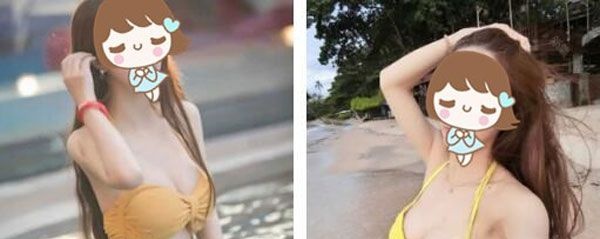 我太瘦了做不成自体脂肪丰胸,于是找昆明博美刘小星院长做了曼托假体隆胸手术 图2