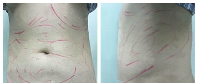 确认过腰腹吸脂不会影响怀孕后到扬州美贝尔做了吸脂术后可以穿露脐装 分享自己的术后护理经验
