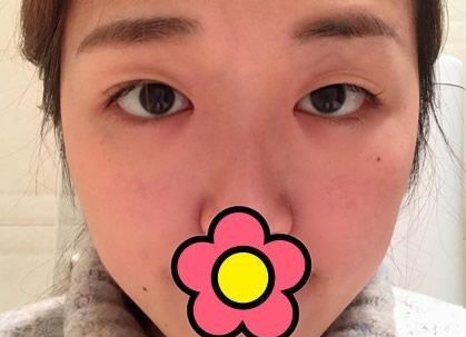 看过我找兰州时光庞艳做的双眼皮案例 就知道兰州时光割双眼皮多少钱了
