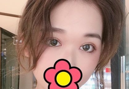 看过我找兰州时光庞艳做的双眼皮案例 就知道兰州时光割双眼皮多少钱了 图2