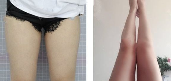 兰州时光整形医院逯岩院长抽脂案例大汇总:快看她们大腿吸脂腰腹吸脂和全身吸脂后的变化