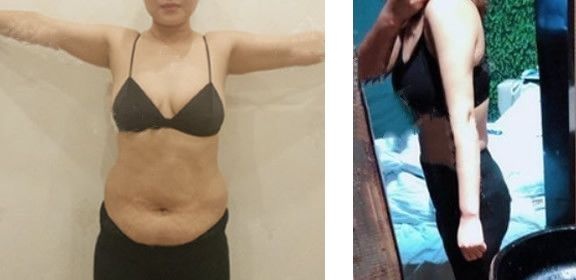 兰州时光整形医院逯岩院长抽脂案例大汇总:快看她们大腿吸脂腰腹吸脂和全身吸脂后的变化 案例图2