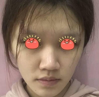 先看看我在杭州薇琳做了全面部埋线提升术效果好不好,再决定做不做面部线雕吧