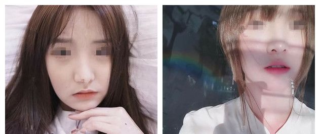 3500元起的兰州和6500元起的美国，纠结后我在扬州美贝尔注射了进口瘦脸改善咬肌大国字脸