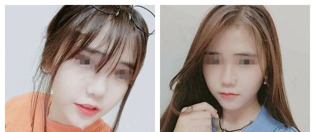 3500元起的兰州和6500元起的美国,纠结后我在扬州美贝尔注射了进口瘦脸改善咬肌大国字脸 图2