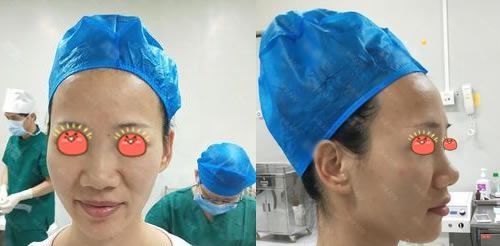 在杭州薇琳做过自体耳软骨鼻综合隆鼻手术的我用亲身经历告诉你,鼻子这样做才好看