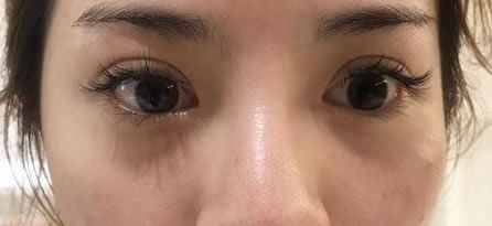 上次在杭州薇琳做的双眼皮,这次回来做的鼻子,有种故地重游的感觉