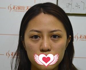 听说自体脂肪面部填充效果会很假?就在前段时间面部凹陷的我在石家庄天宏做了大腿吸脂和面部填充脂肪术后不仅自然还有满满的少女感