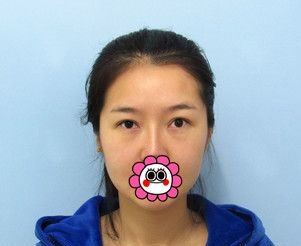 在哈尔滨索菲做了皮肤项目后找陈富全做了内路祛眼袋，朋友看到效果不错也做了同样的手术