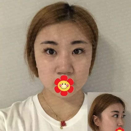 绍兴做鼻子哪个医院好,我选择绍兴维美康乐做了假体+耳软骨综合隆鼻,成功摆脱“扁塌鼻”